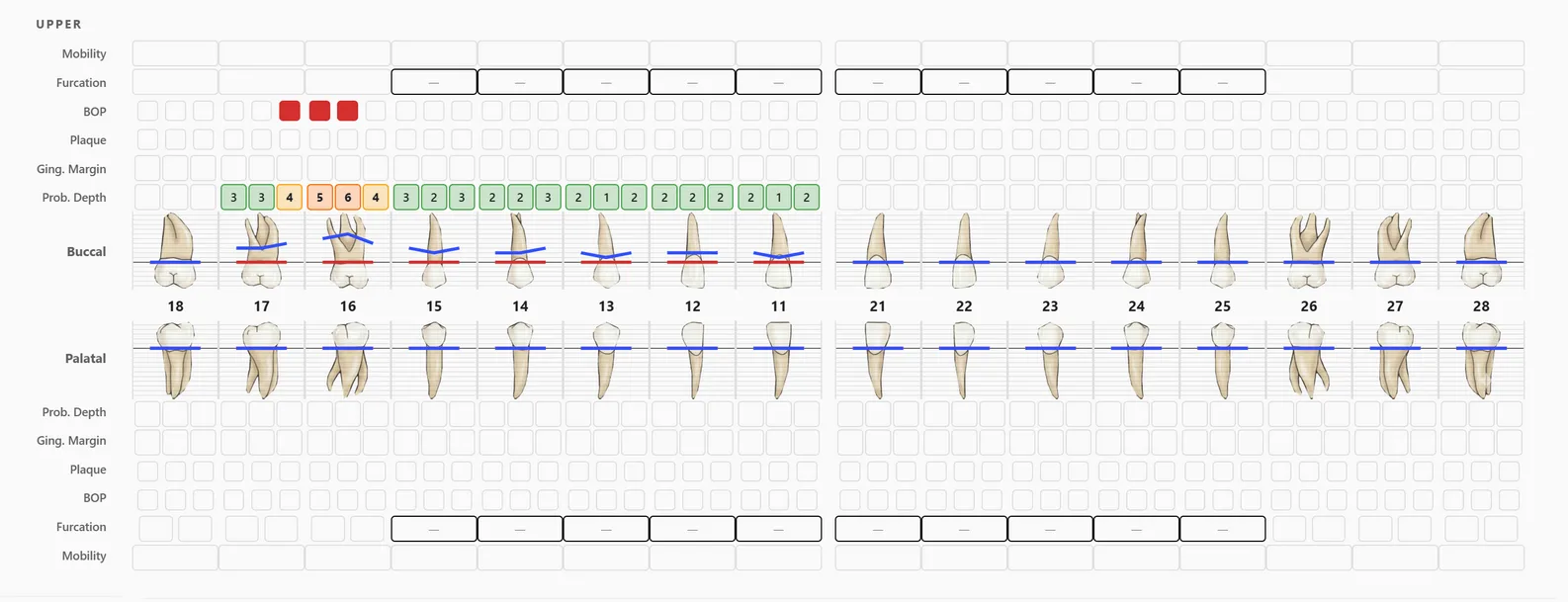 Upper arch of a periodontal chart with probing depths, bleeding points and gingival lines — FindClinica dentist & medical software